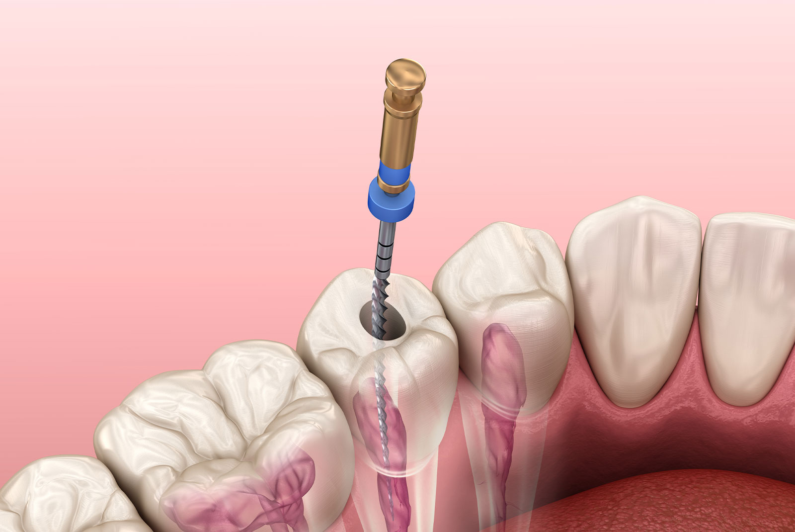 root canal illustration