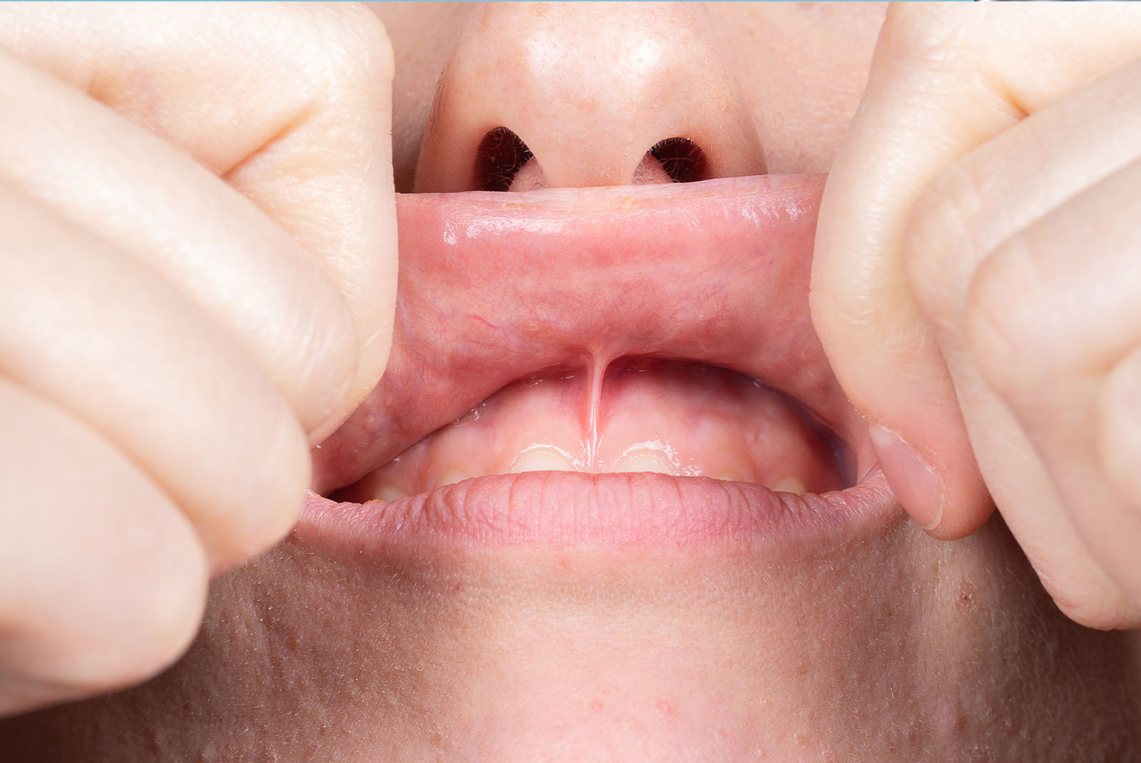 frenectomy examination example