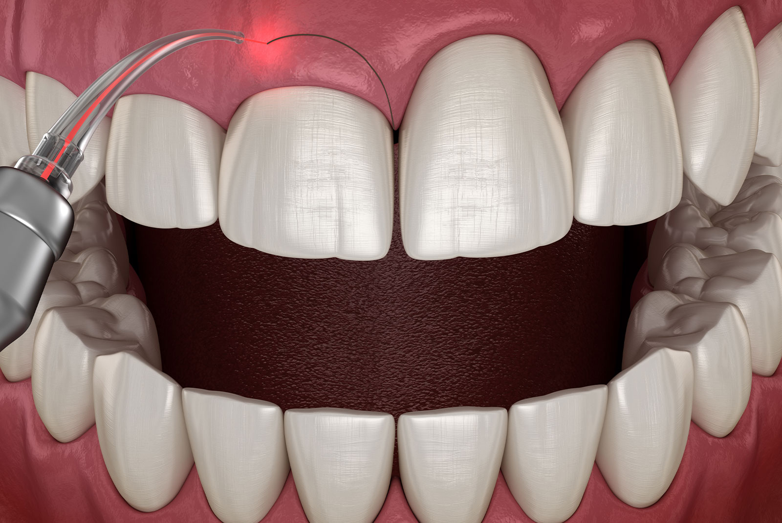 gum disease laser treatment illustration