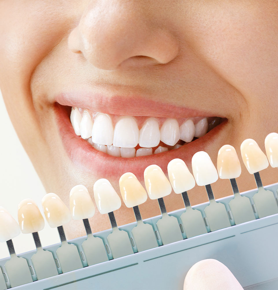 close up of dental patient having a whitening scale