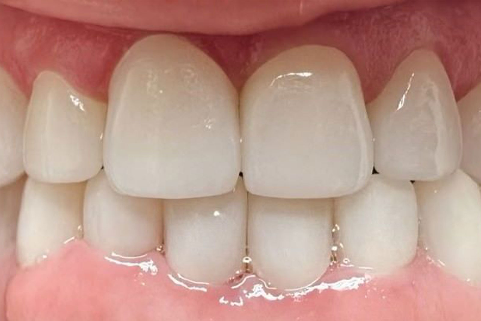 Before and After procedure images up close