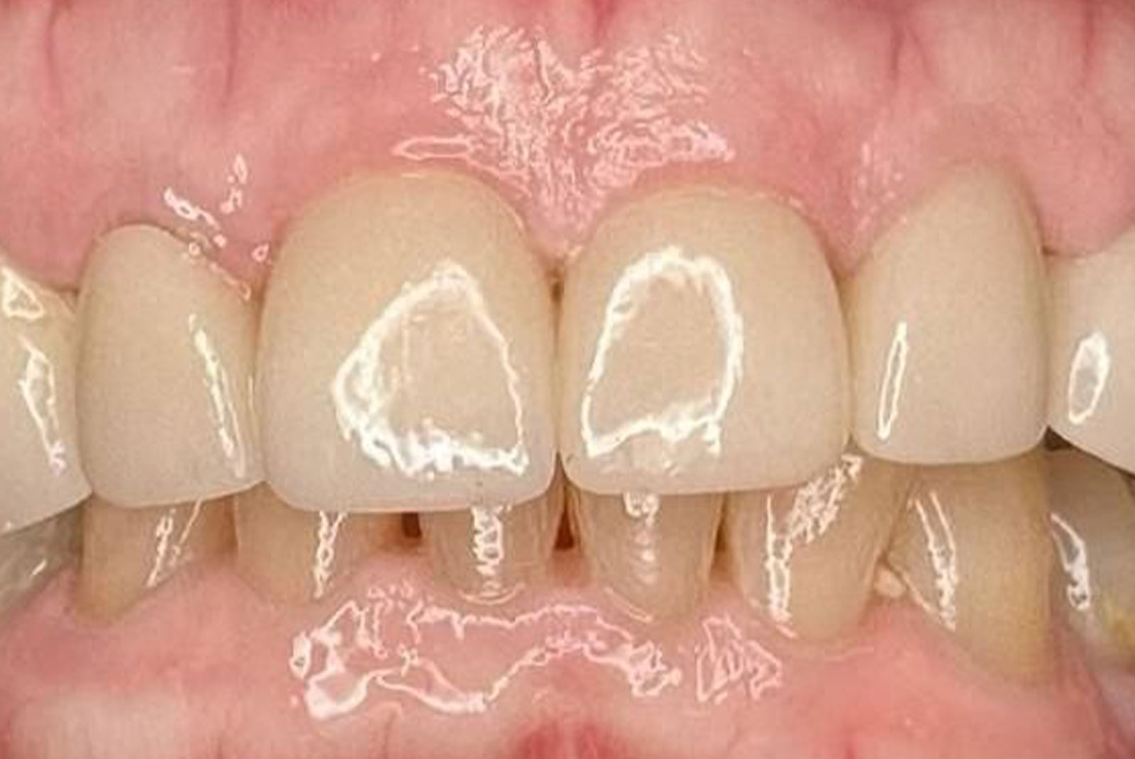Before and After procedure images up close