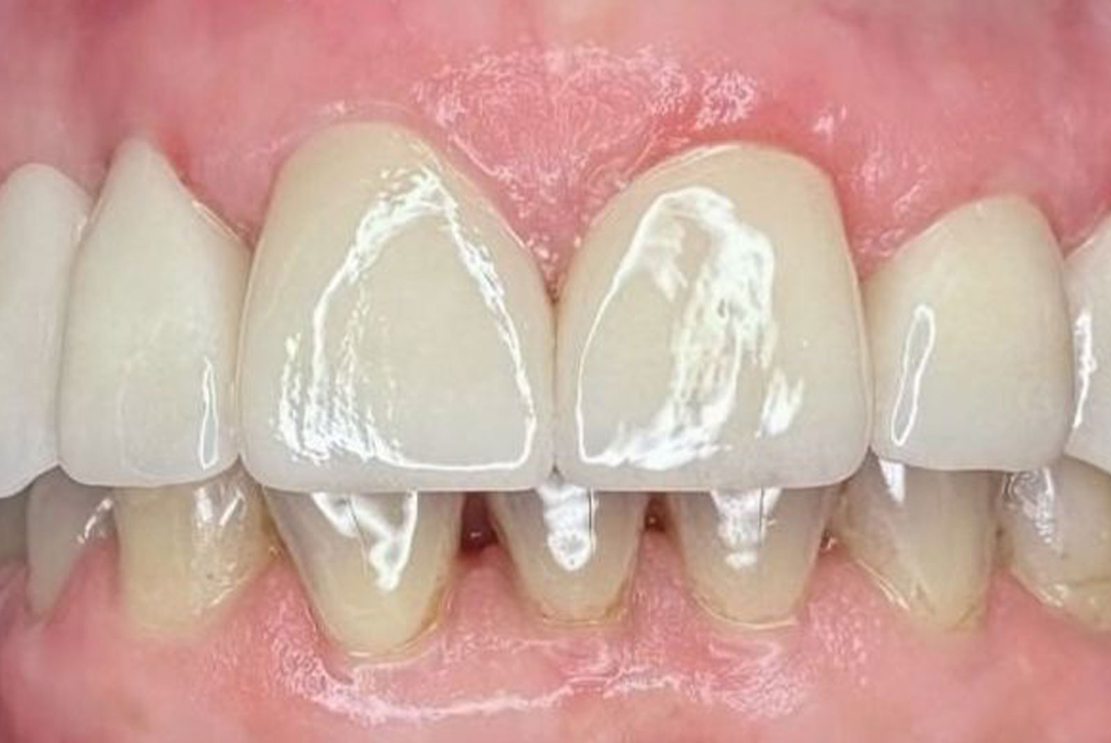 Before and After procedure images up close