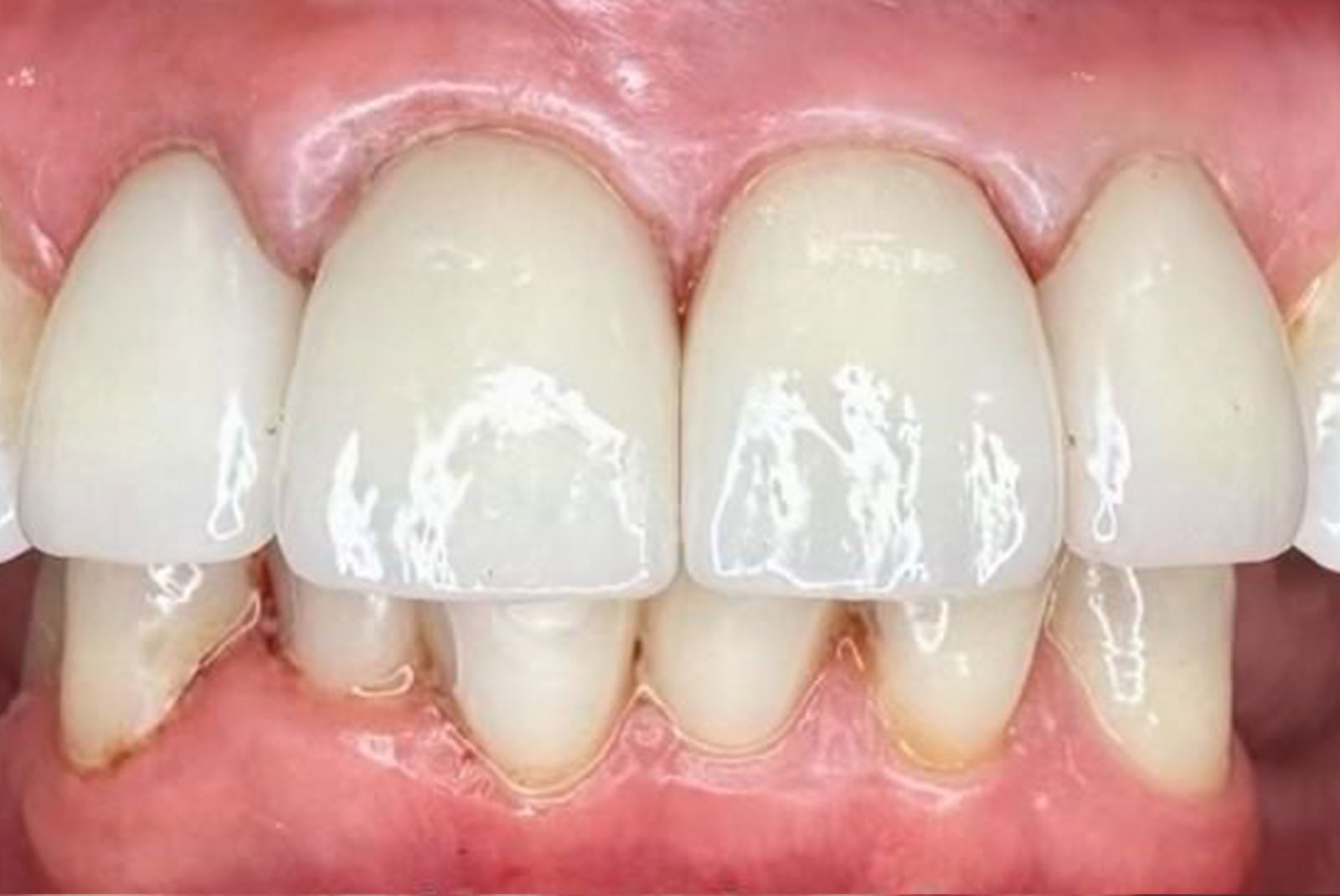 Before and After procedure images up close