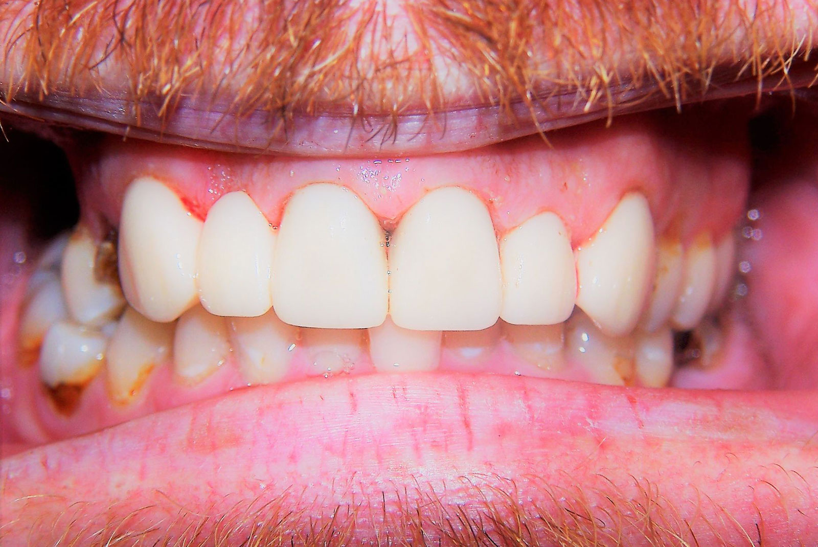 Before and After procedure images up close