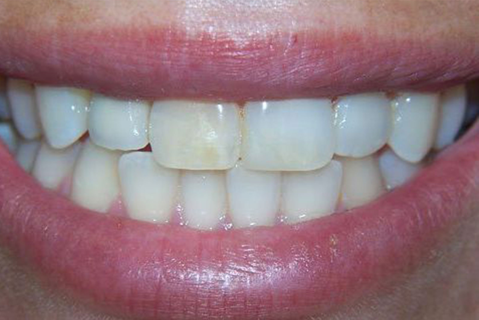 Before and After procedure images up close