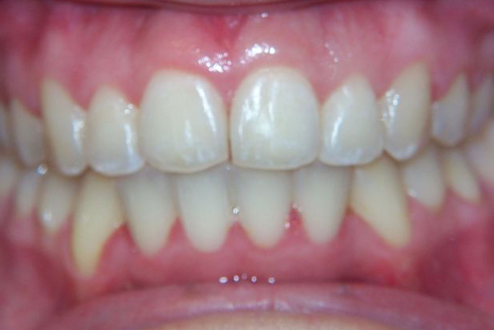 Before and After procedure images up close