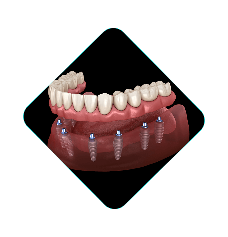 illustration of all on 6 full arch dental impants