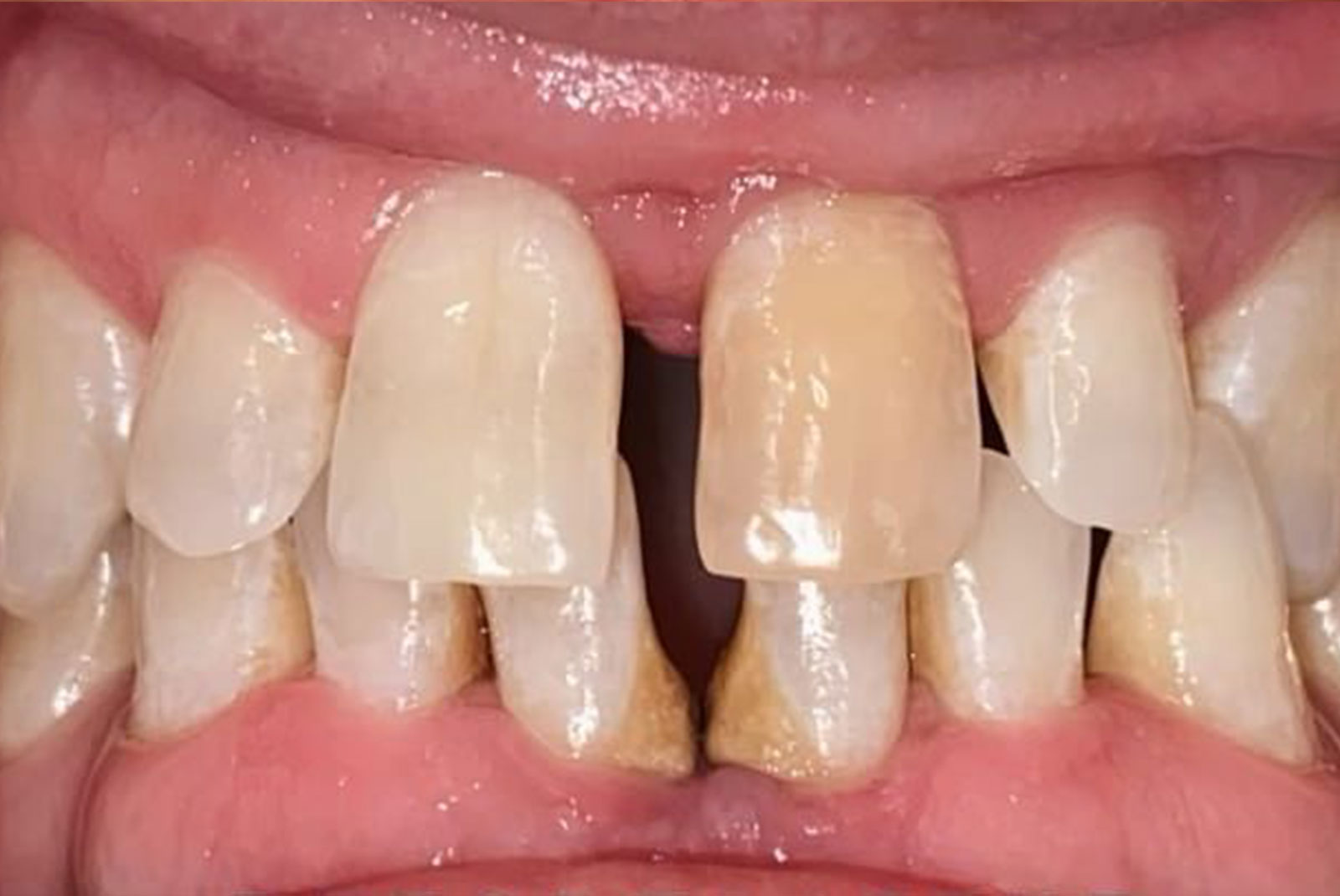 Before and After procedure images up close