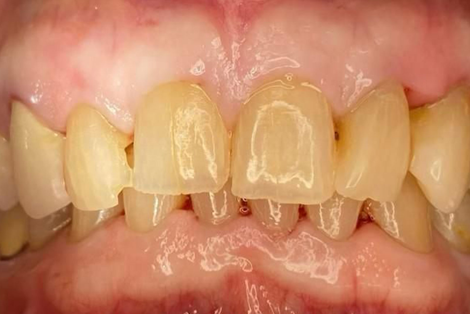 Before and After procedure images up close