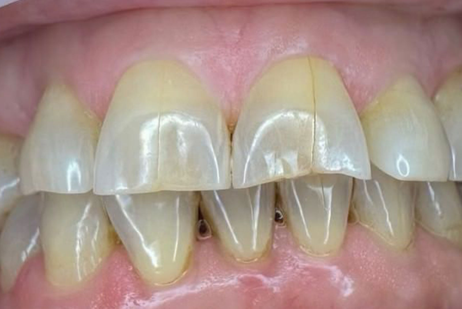 Before and After procedure images up close