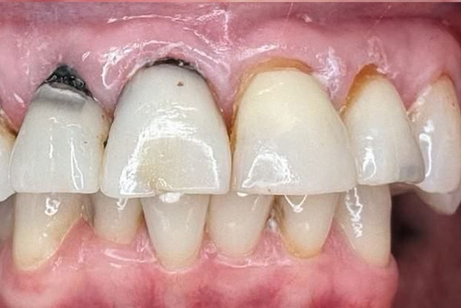 Before and After procedure images up close