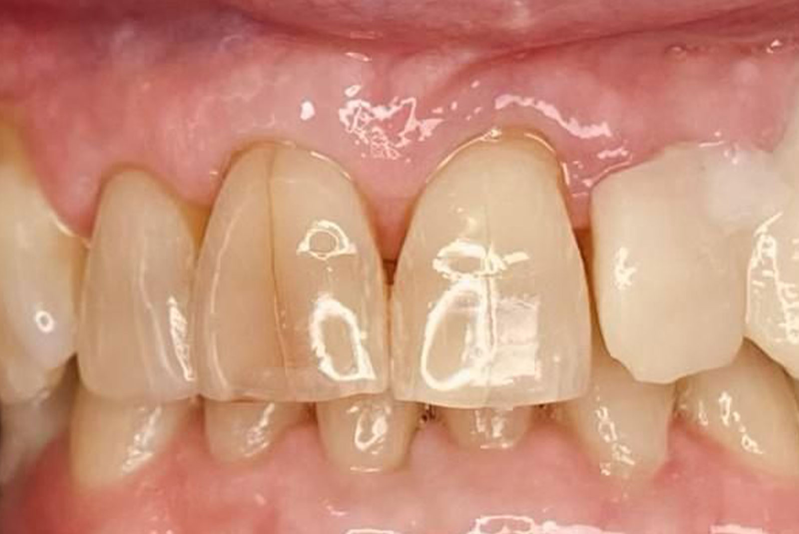 Before and After procedure images up close
