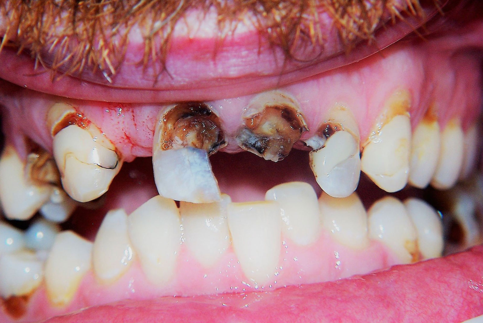 Before and After procedure images up close