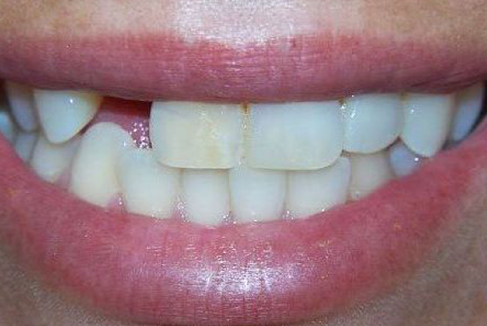 Before and After procedure images up close