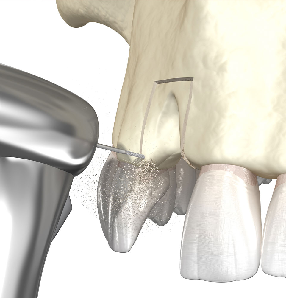 illustrated procedure of bone grafting