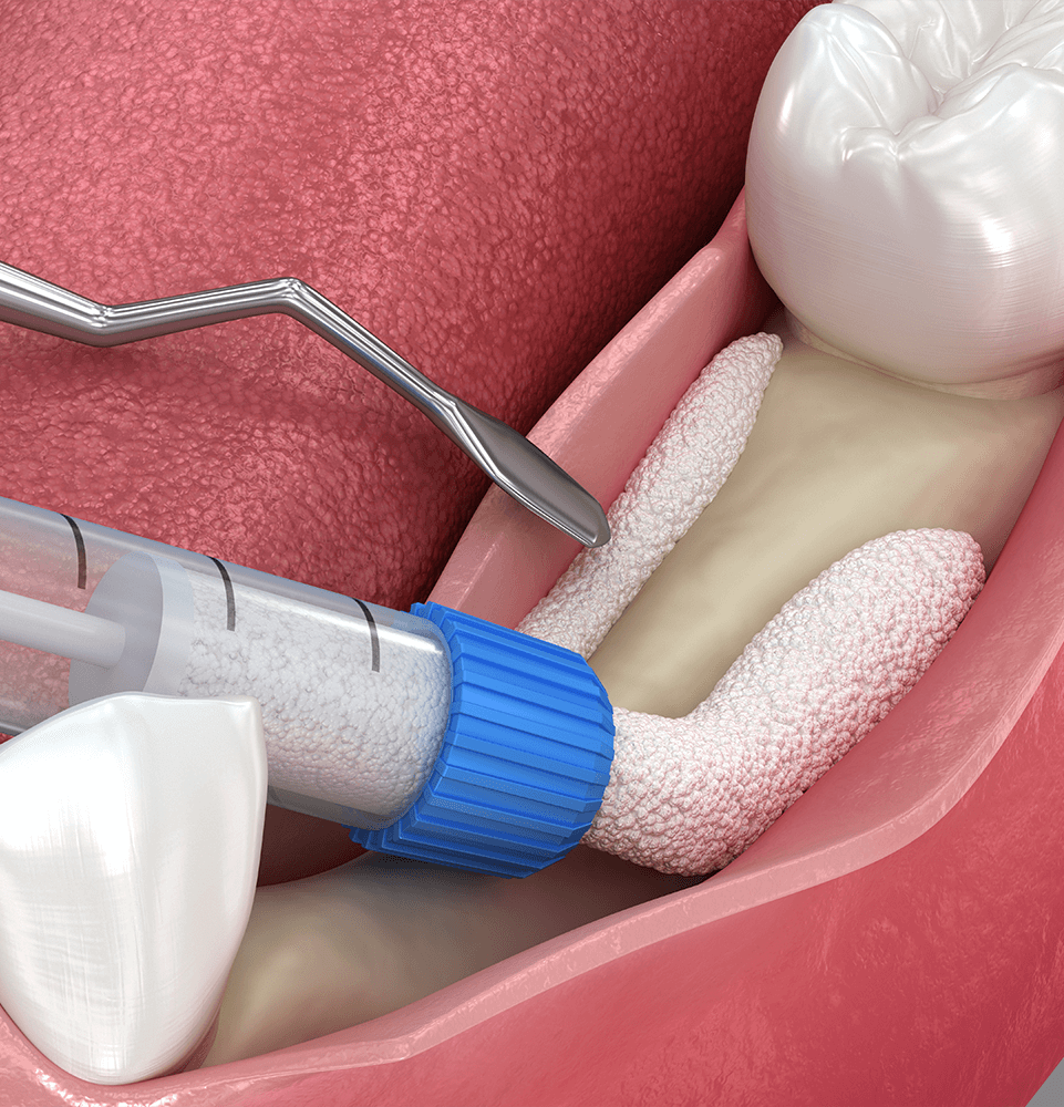 illustrated procedure of bone grafting