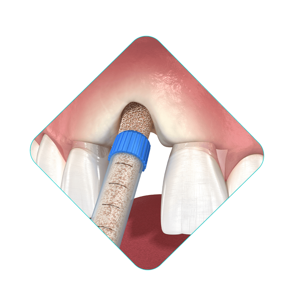 bone grafting illustration