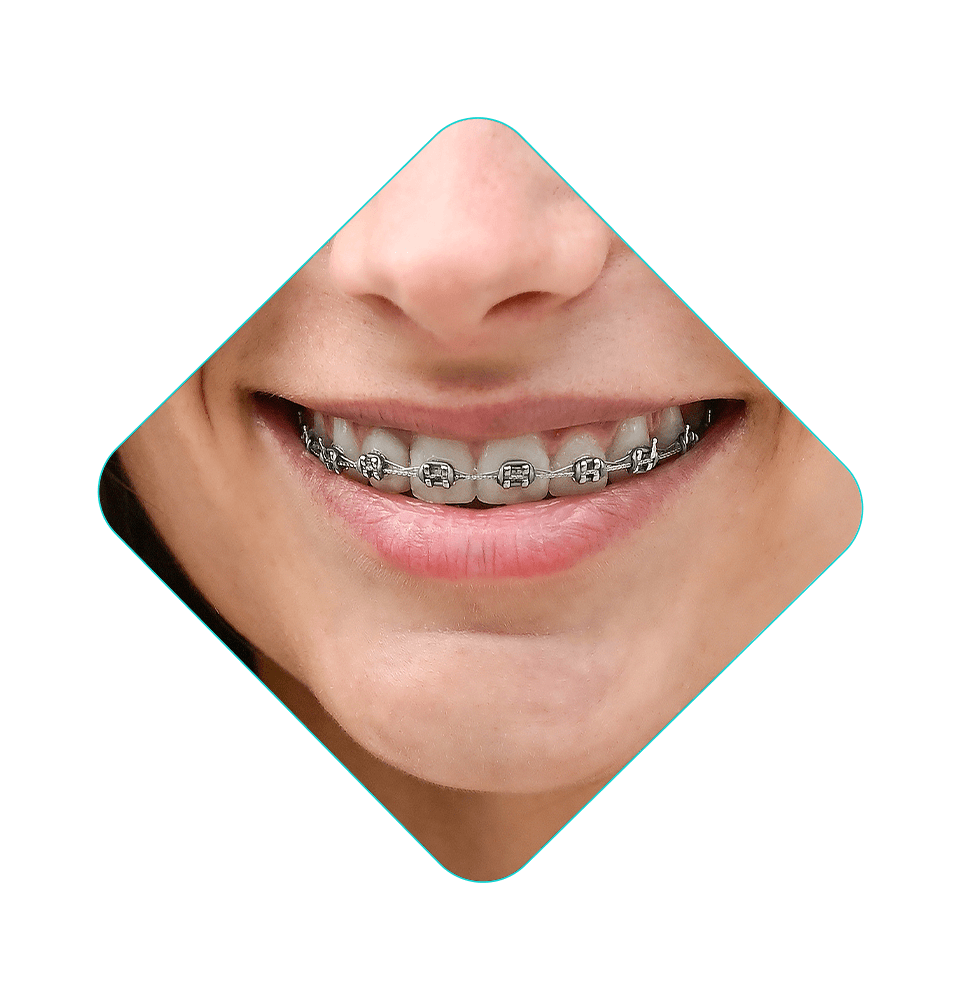 close up of person with braces