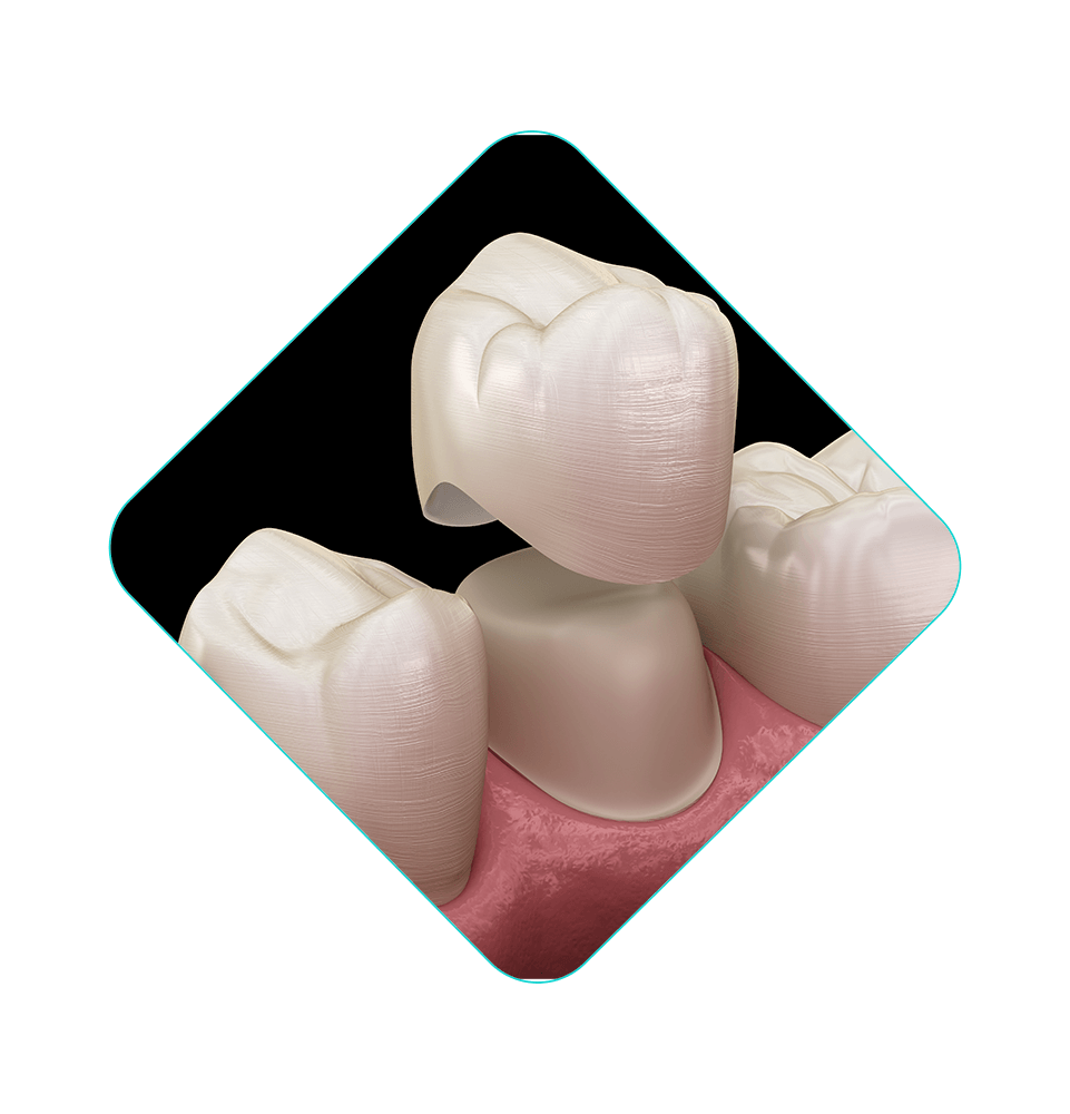 dental crown illustration
