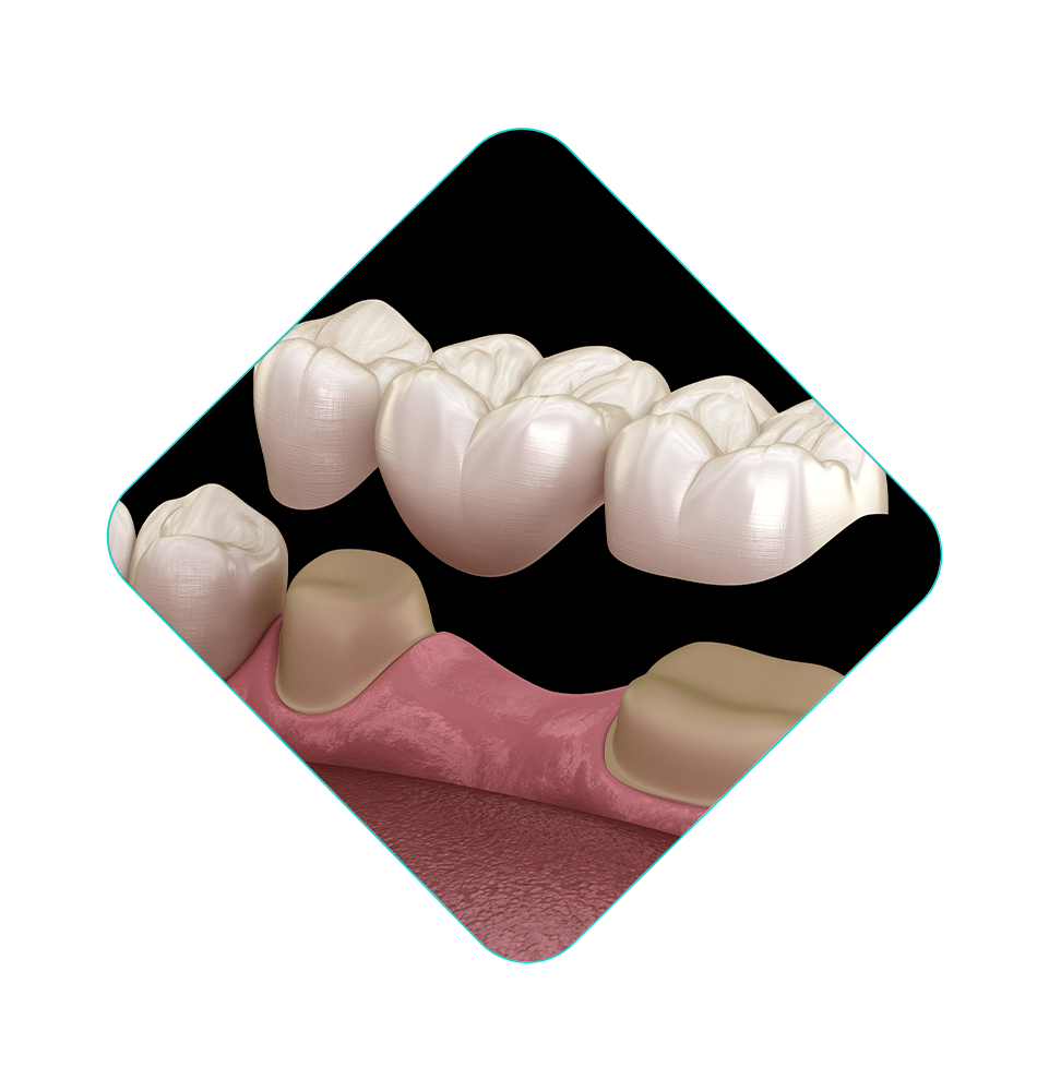 illustrated dental bridge