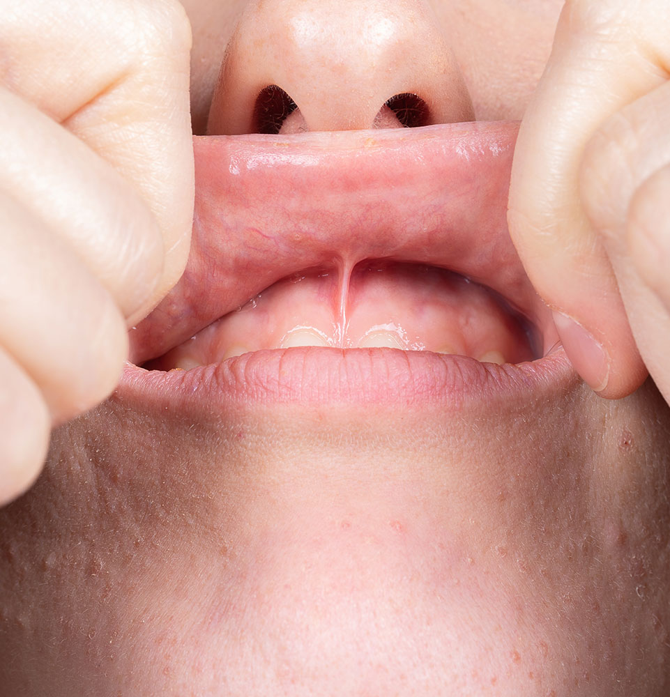 person holding up their upper lips for examination
