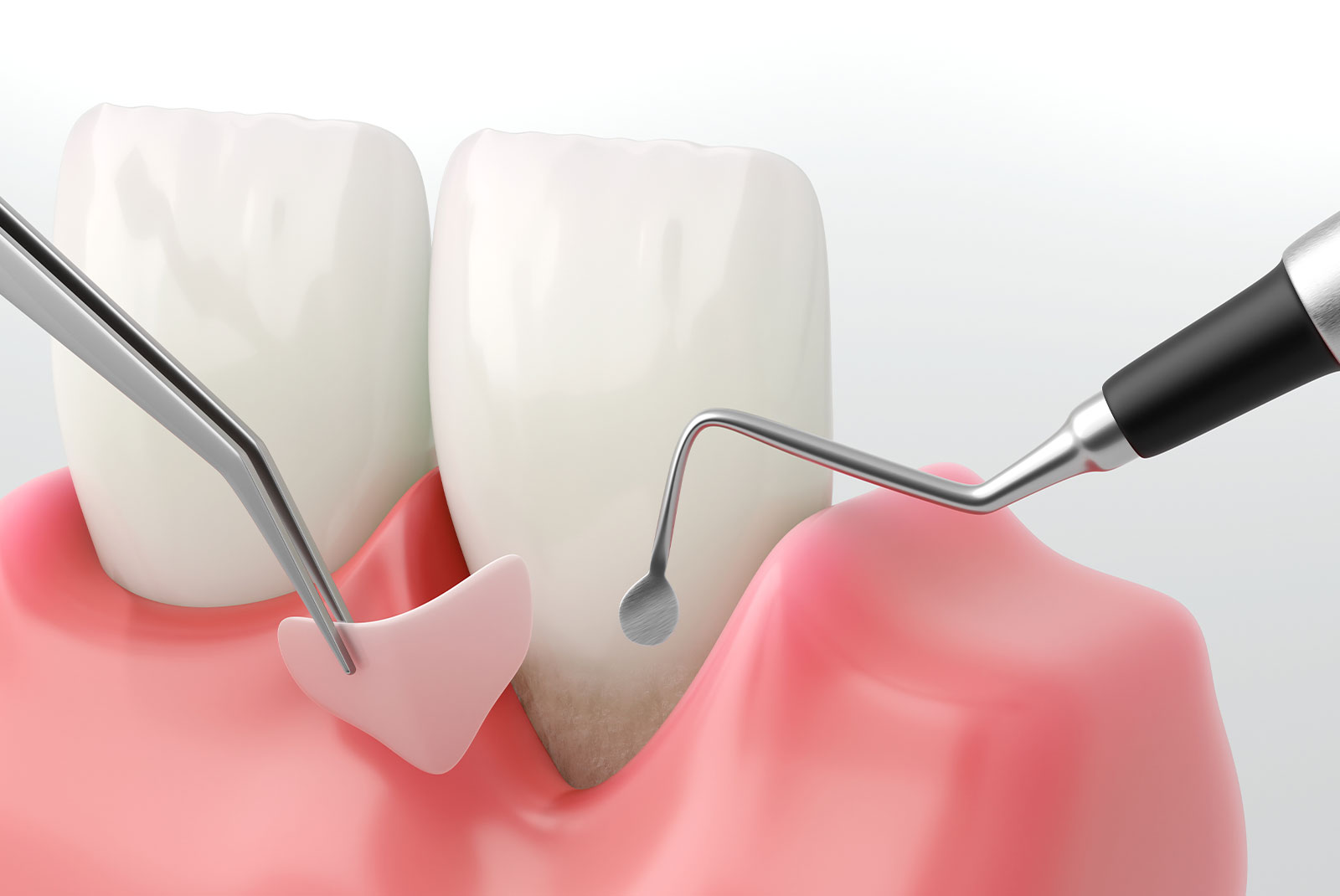 gum grafting illustration