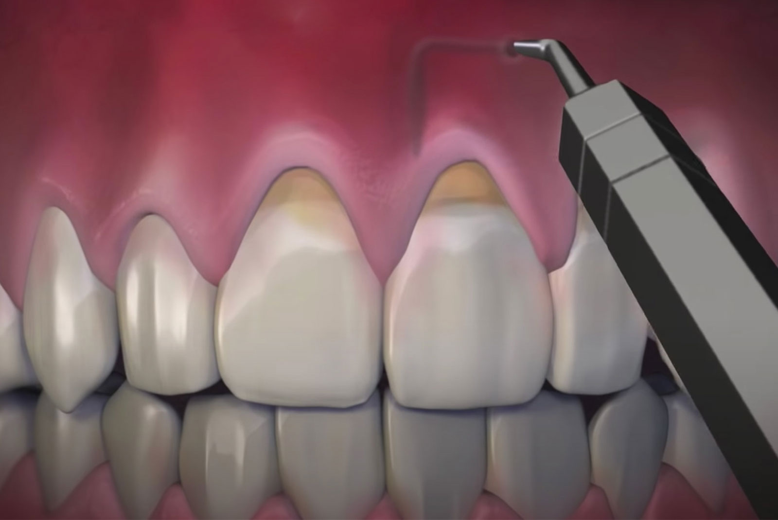 pinhole procedure illustration