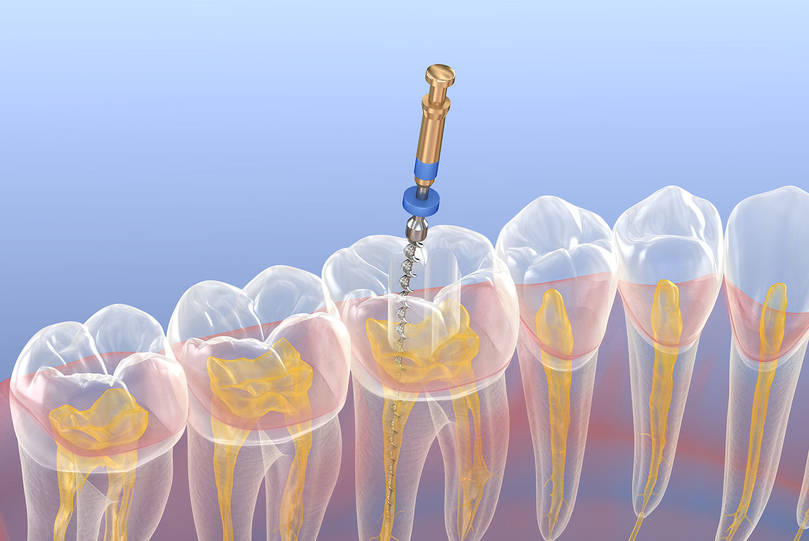 root canal therapy treatment illustration