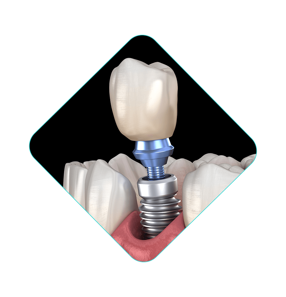 close up illustrated dental implant