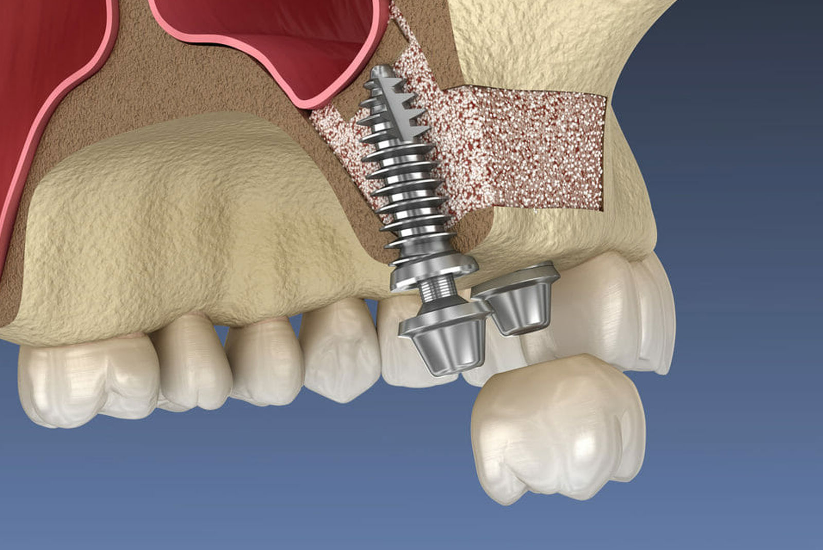 Sinus Lift Procedure at Dental Arts of Catoosa | Trusted Dental