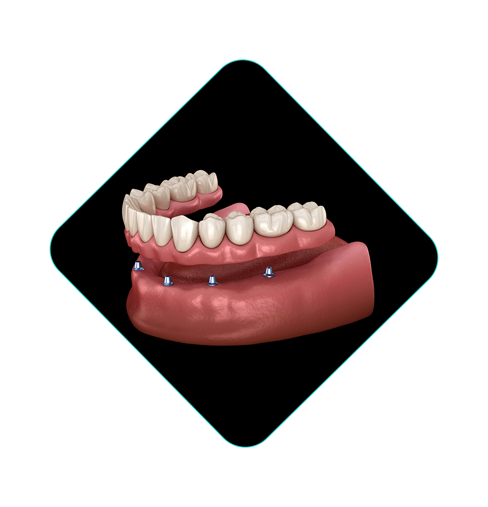 illustration of full arch dental implant