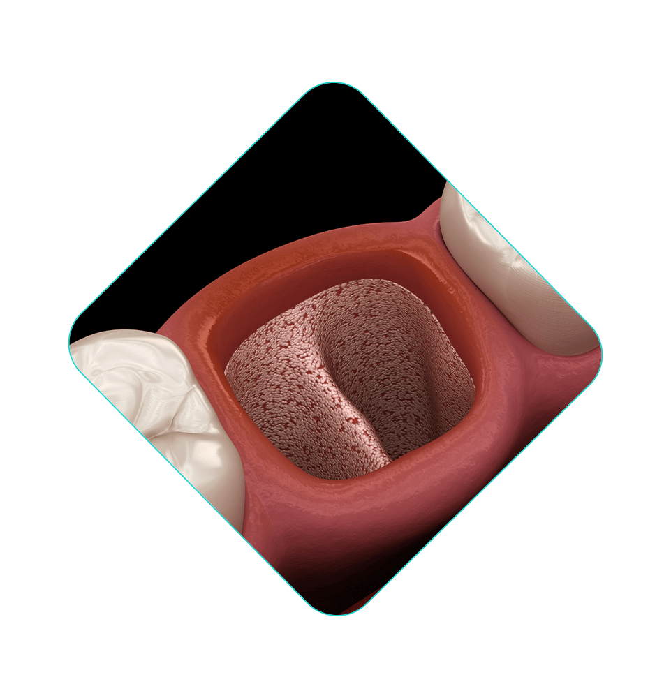 tooth extraction illustration