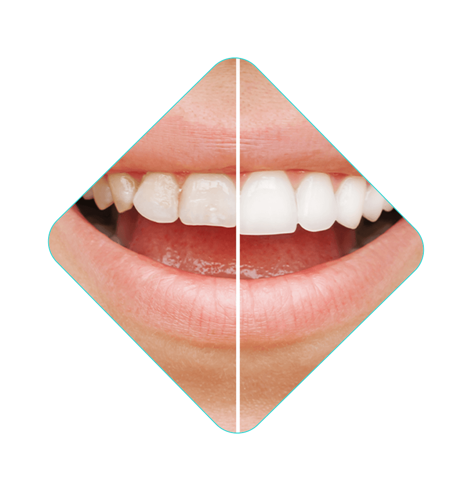 comparison slider of teeth whitening procedure