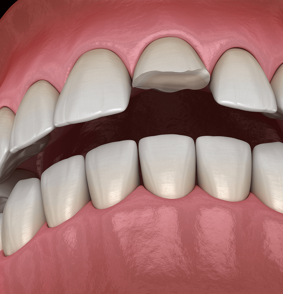 illustration of chipped and cracked tooth