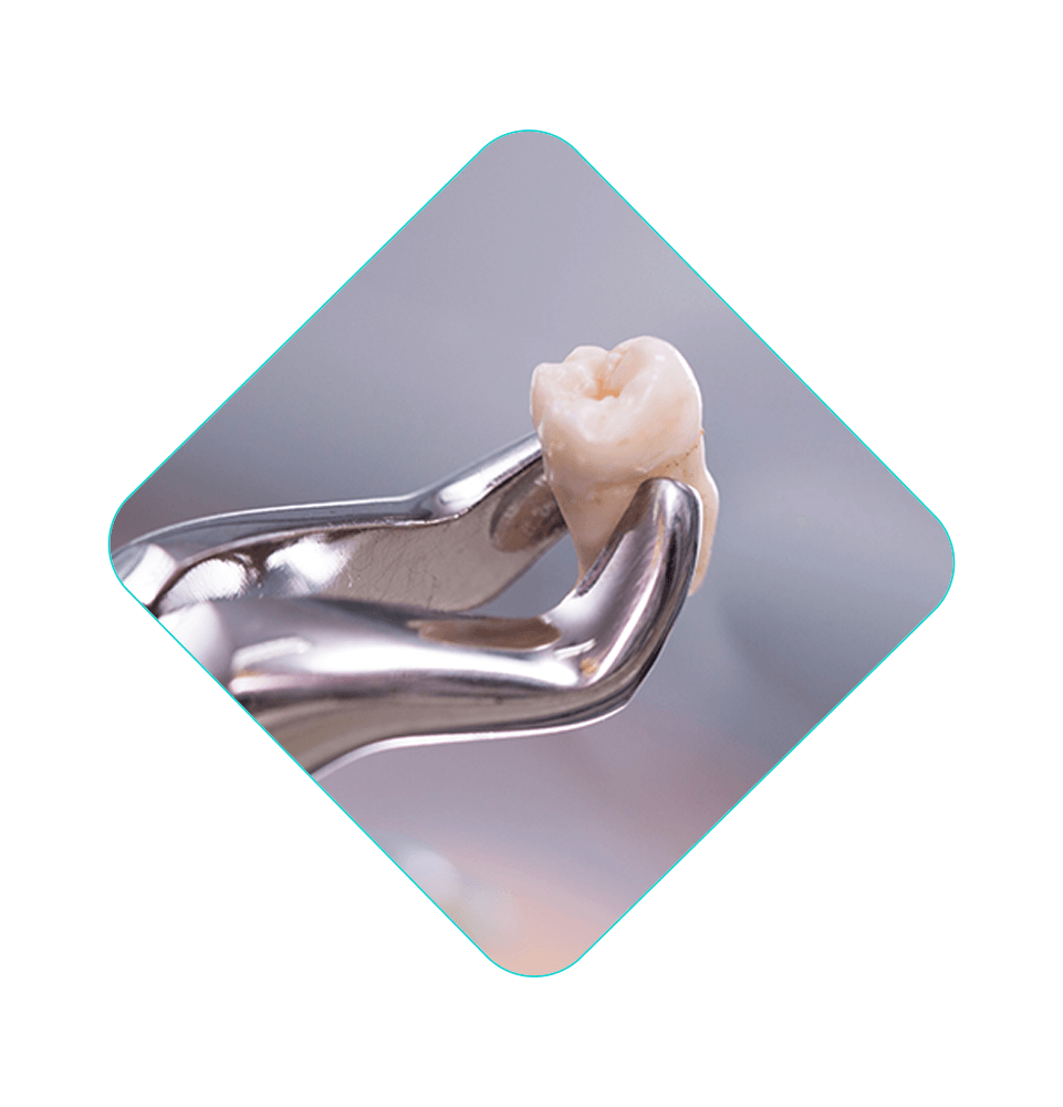 close up of extracted wisdom tooth