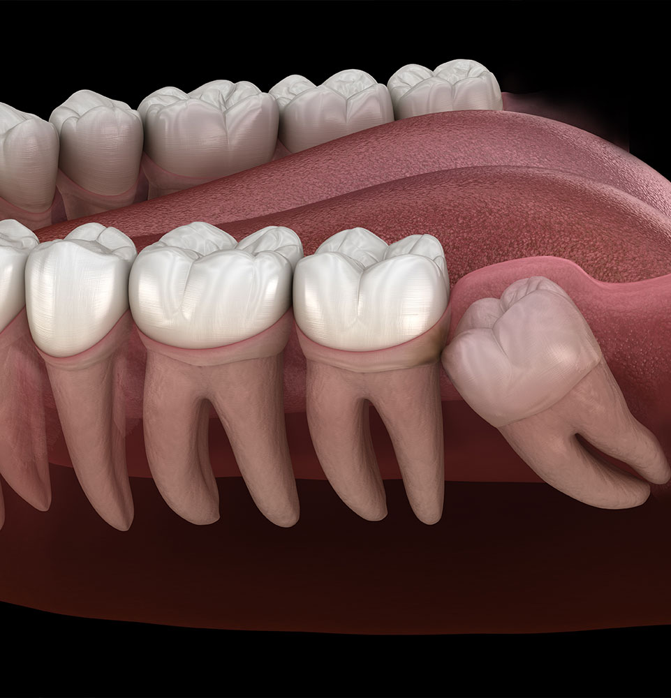 illustrated wisdom tooth in mouth