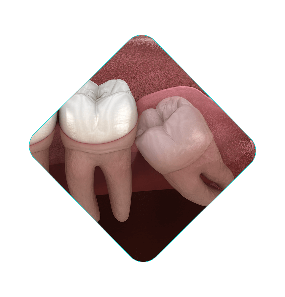 wisdom tooth illustration